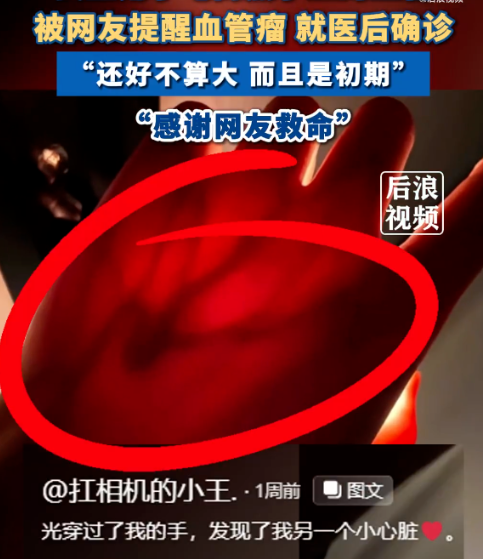 女生曬手電照手圖被提醒疑似血管瘤